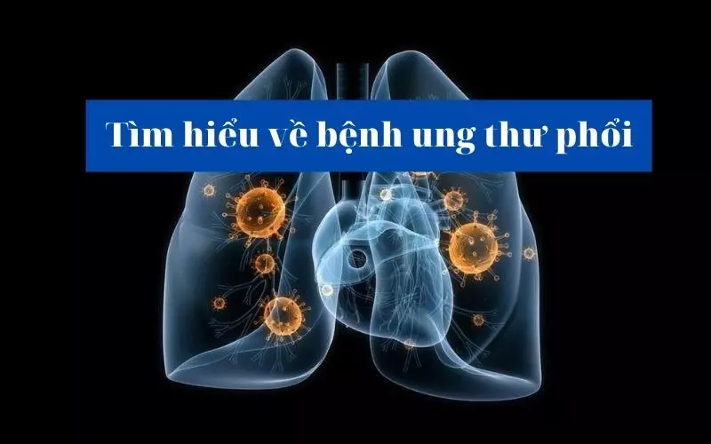 Nhận biết về ung thư phổi để tầm soát và điều trị kịp thời
